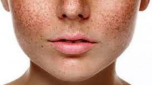 درمان لک های پوستی