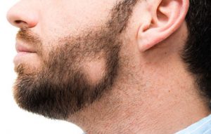 عوامل موثر در ریزش موی صورت آقایان