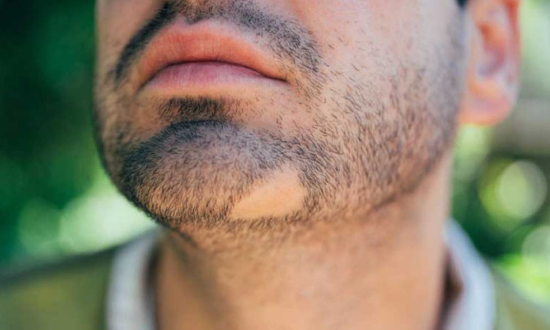 عوامل موثر در ریزش موی صورت آقایان